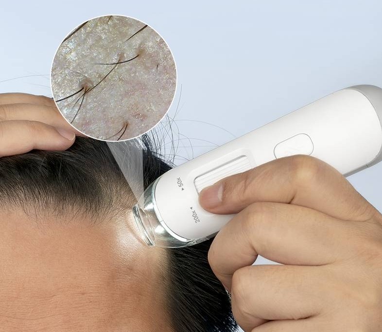 頭皮檢測儀原理 頭皮檢測儀原理